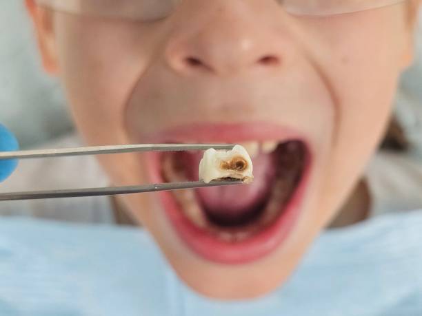 Best Emergency Tooth Extraction in South Waverly, PA